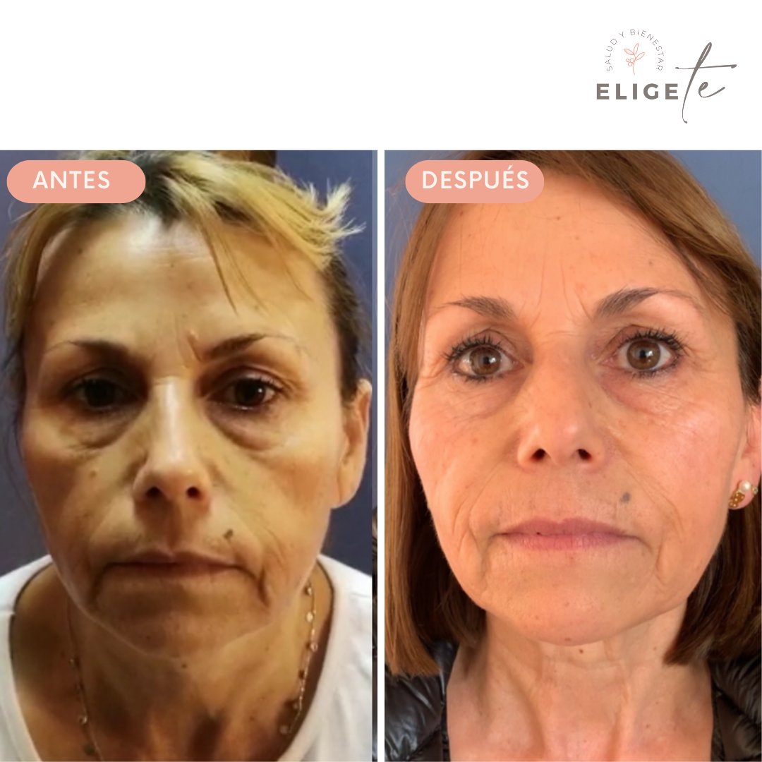 Rejuvenecimiento Facial con Radiofrecuencia Exilis Elite 10 Sesiones