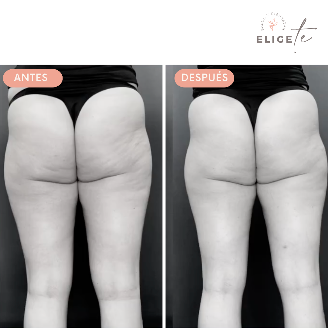 Cellulistop: Mejora la apariencia de tu piel y combate la flacidez