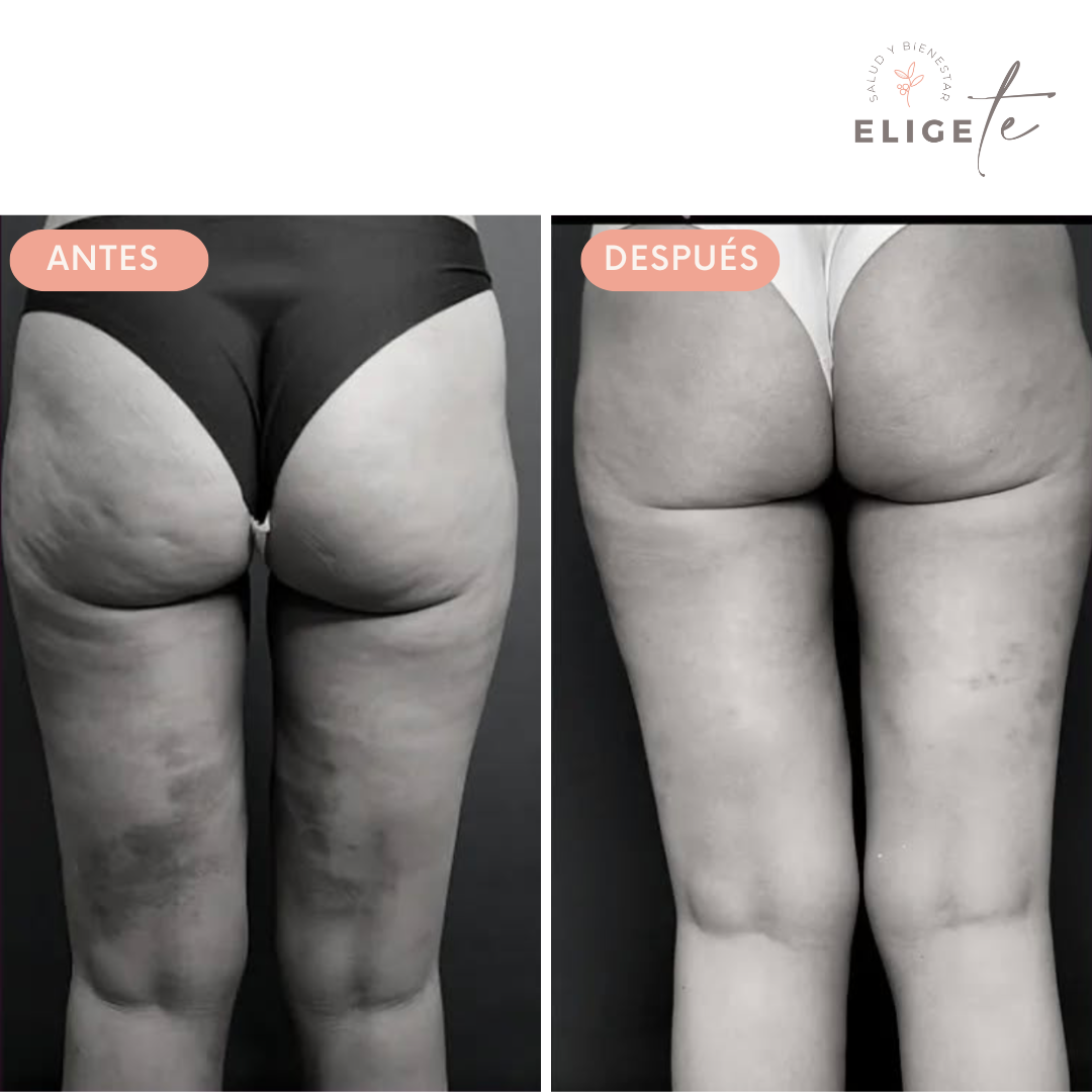 Cellulistop: Mejora la apariencia de tu piel y combate la flacidez