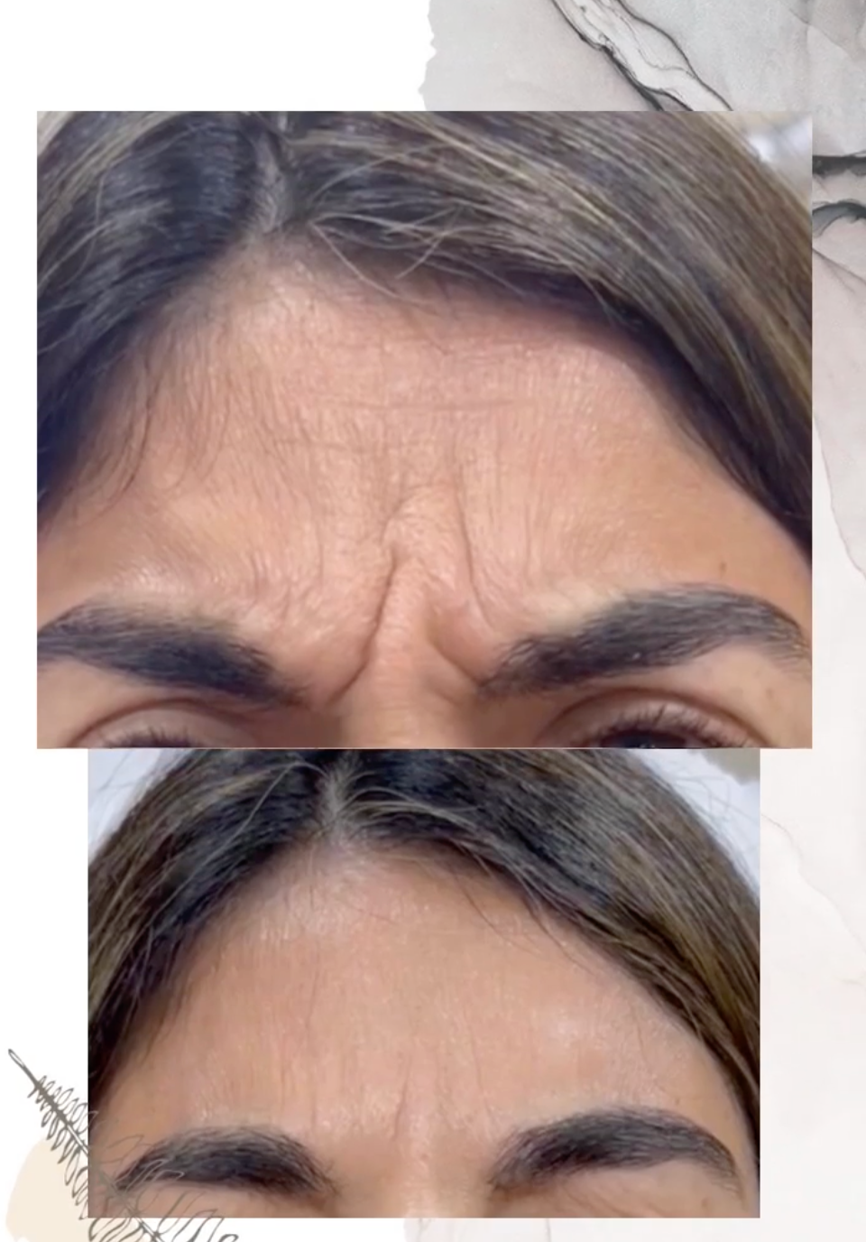 Rejuvenece tu Rostro al Instante - Botox ¡3 zonas!