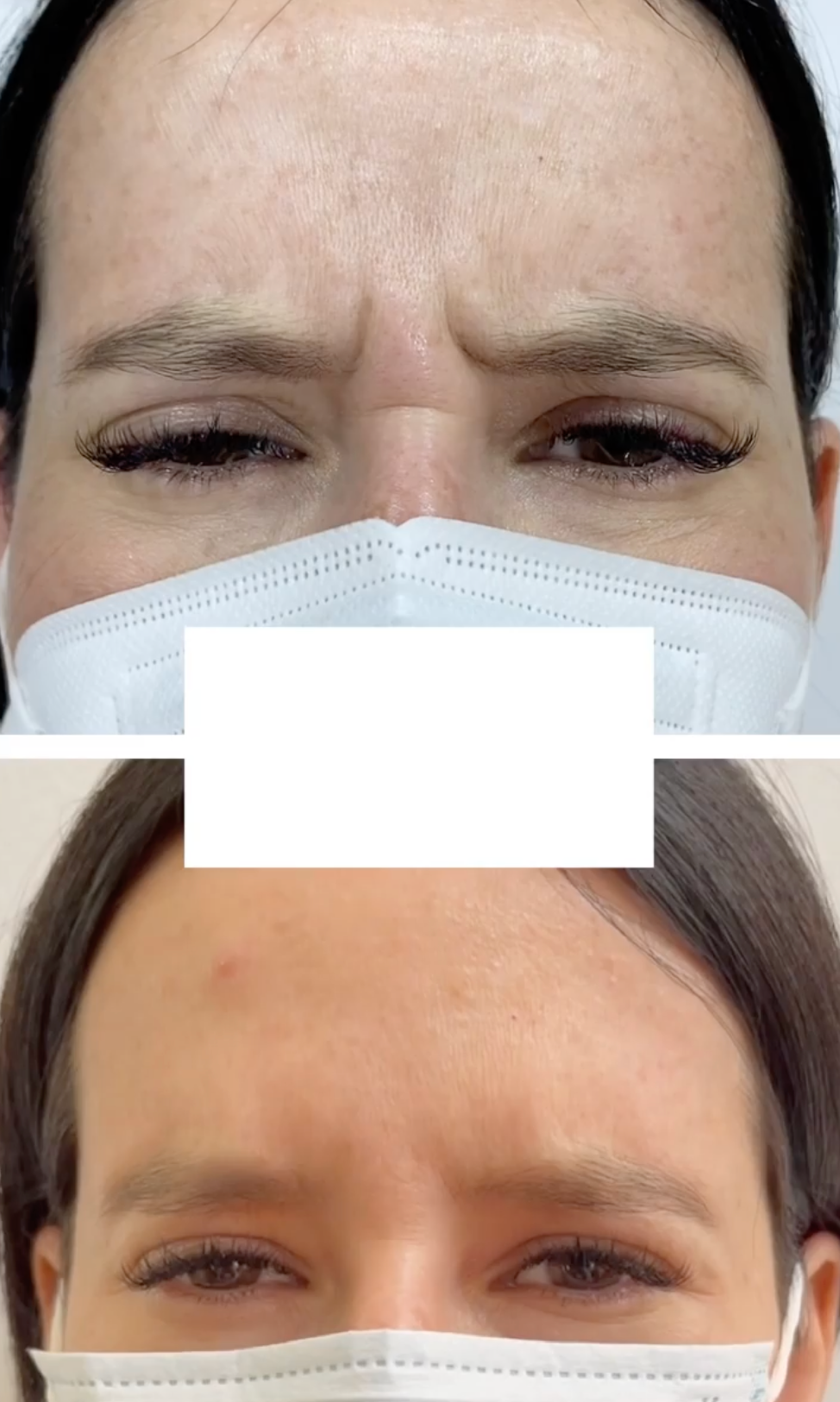 Rejuvenece tu Rostro al Instante - Botox ¡3 zonas!