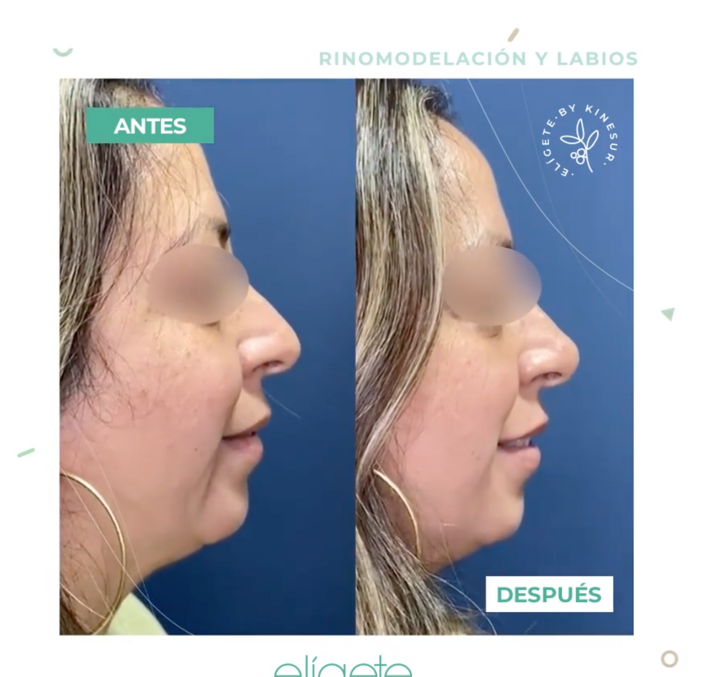 Rinomodelación - Remodela tu Nariz Sin Cirugía