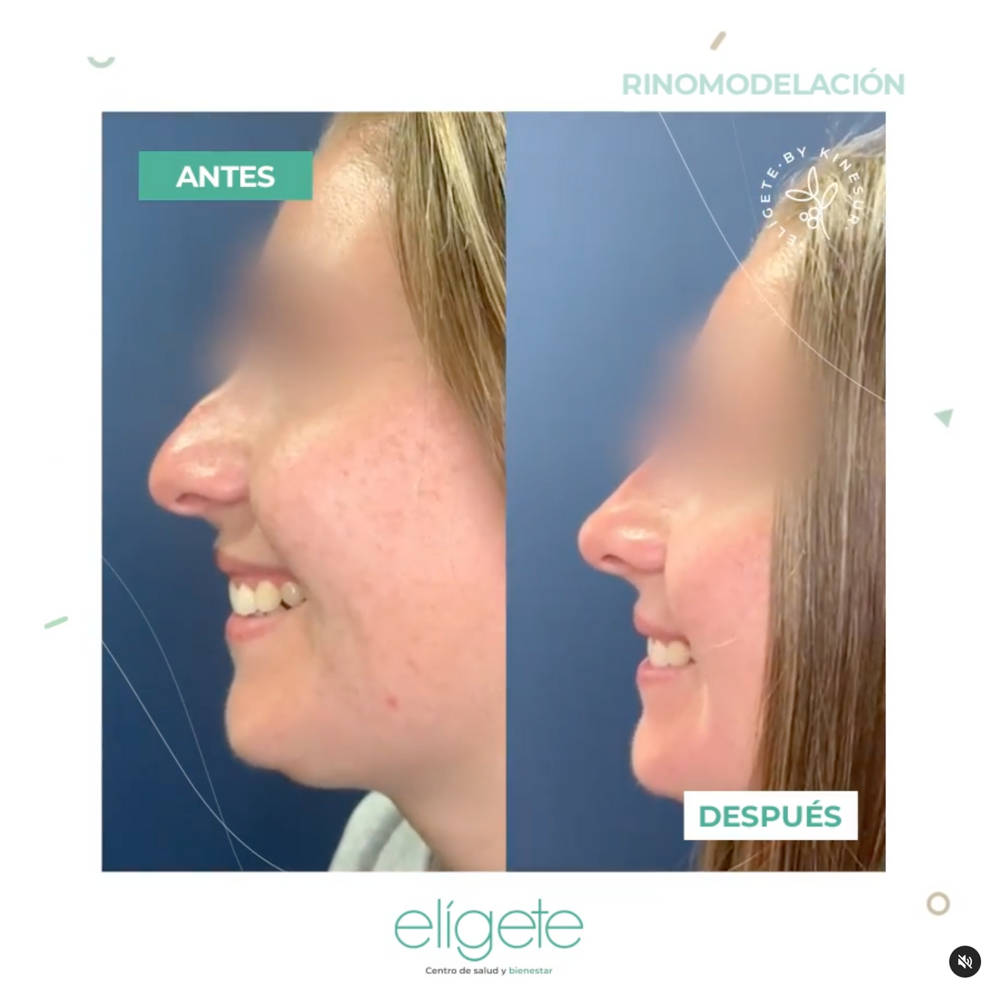 Rinomodelación - Remodela tu Nariz Sin Cirugía