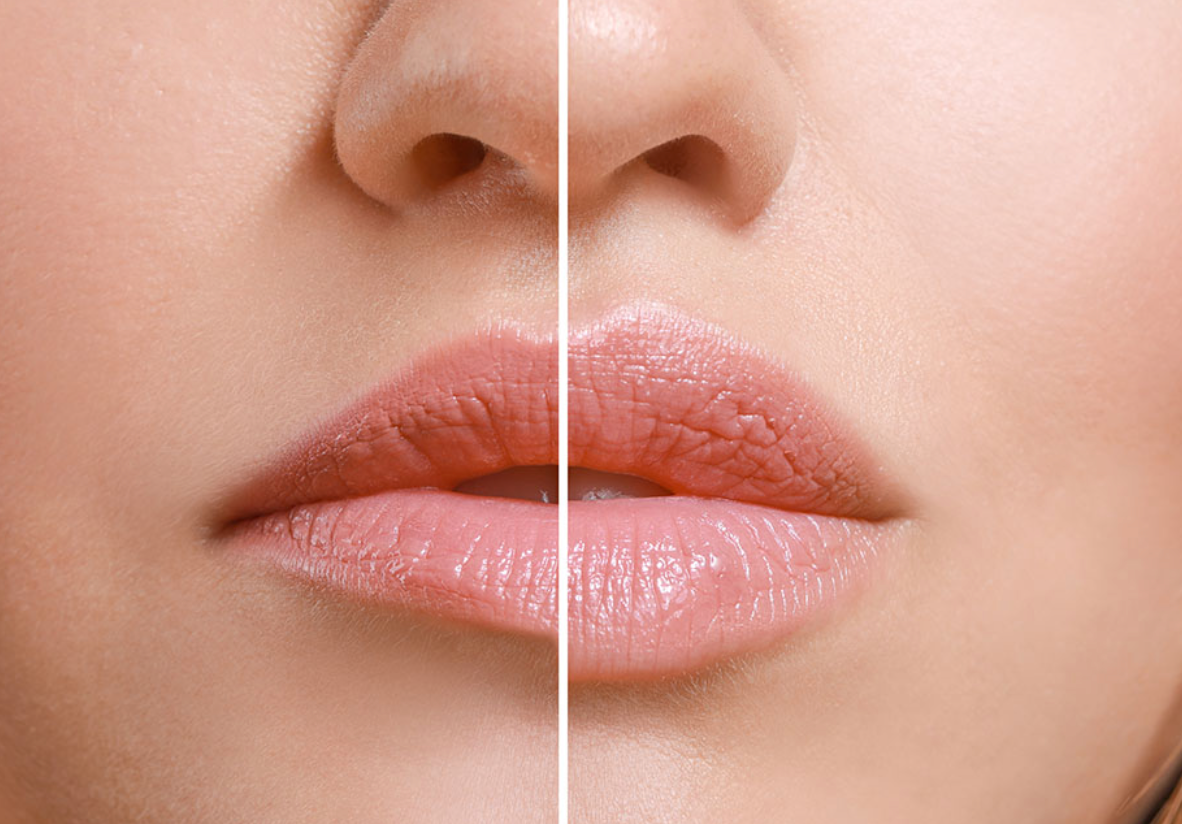 Relleno de Labios - Volumen, Definición y Juventud al Instante