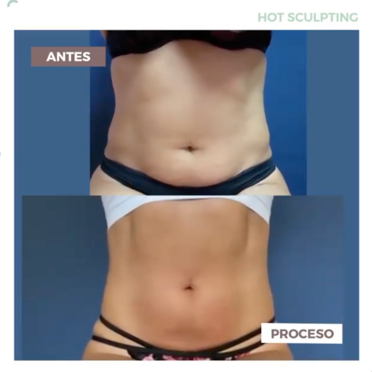 Hot Sculpting: Reducción de Grasa y Escultura Corporal