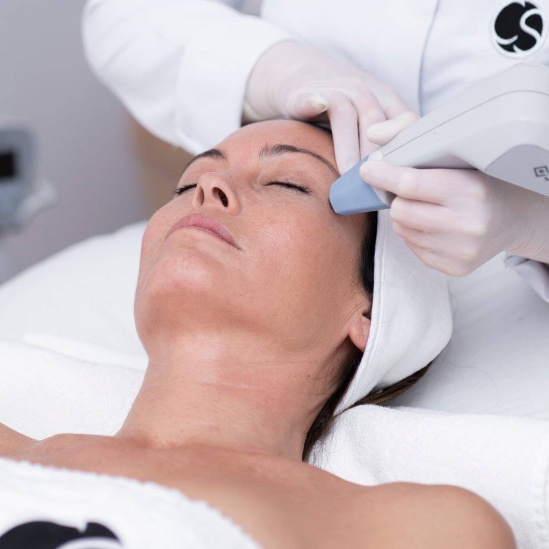 Rejuvenecimiento Facial con Radiofrecuencia Exilis Elite 10 Sesiones