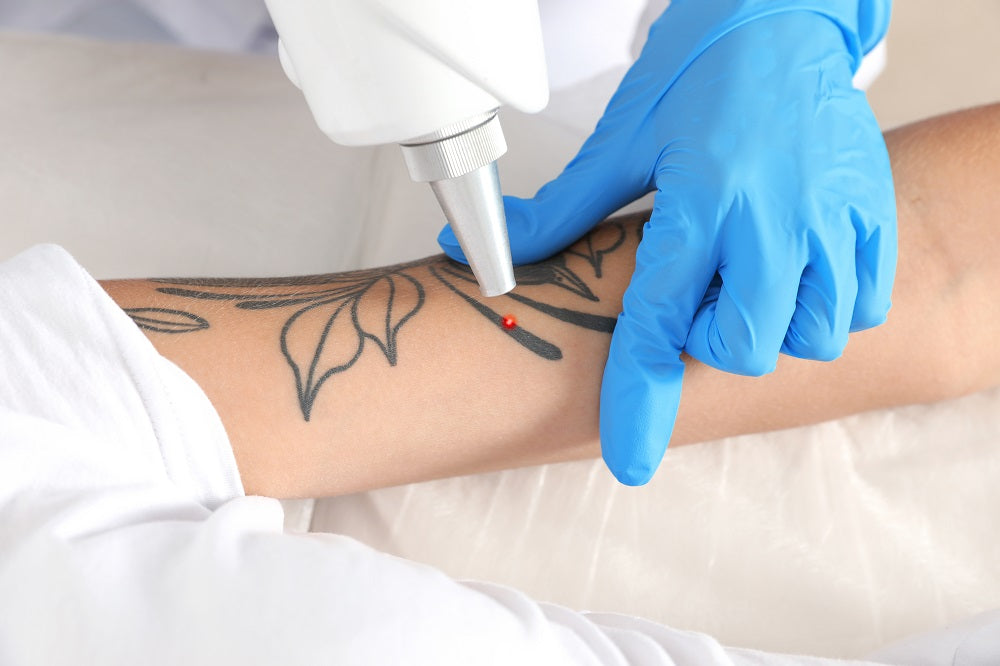 Eliminación de Tatuajes con Láser Nd:YAG - 7 Sesiones