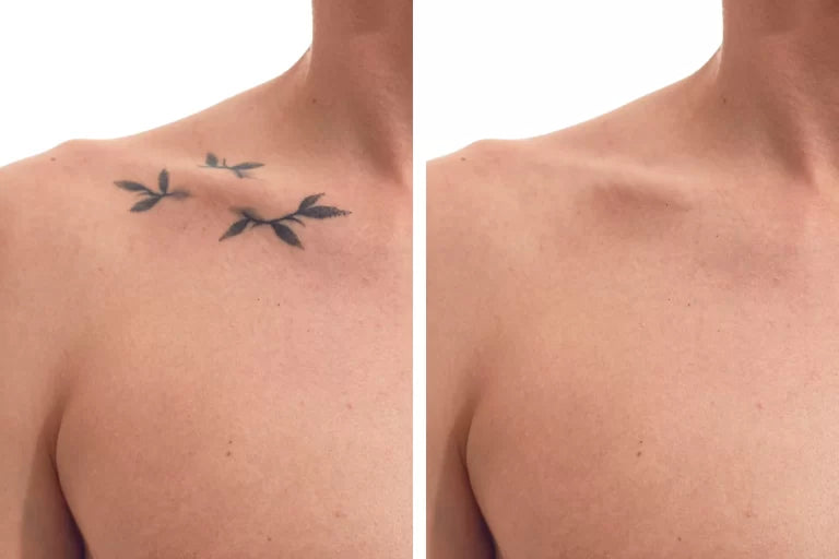 Eliminación de Tatuajes con Láser Nd:YAG - 7 Sesiones