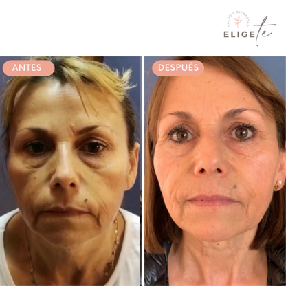 Rejuvenecimiento Facial con Radiofrecuencia Exilis Elite 10 Sesiones