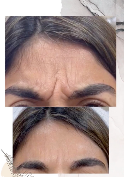 Rejuvenece tu Rostro al Instante - Botox ¡3 zonas!
