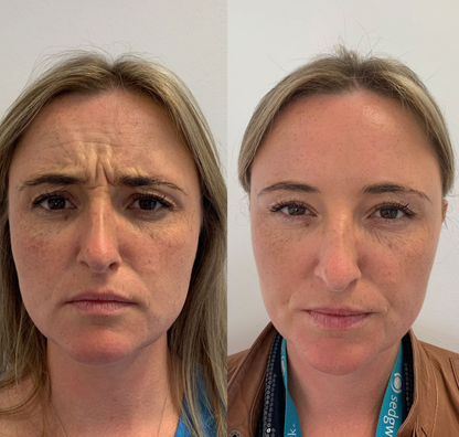 Rejuvenece tu Rostro al Instante - Botox ¡FULL FACE!