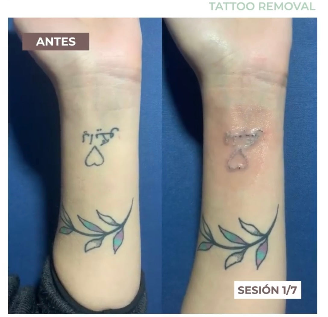 Eliminación de Tatuajes con Láser Nd:YAG - 7 Sesiones