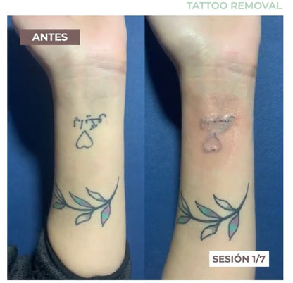 Eliminación de Tatuajes con Láser Nd:YAG - 7 Sesiones
